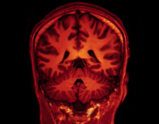La depressione danneggia alcune zone del cervello