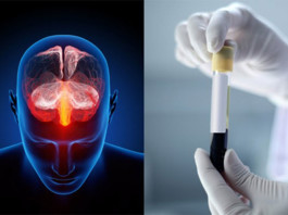 Diagnosticare la depressione con un esame del sangue